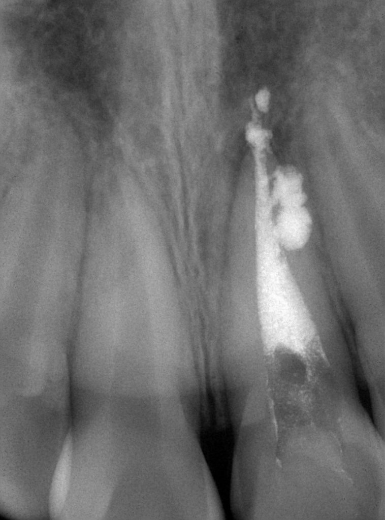 歯の根管　側枝の存在　あいざわ歯科クリニック